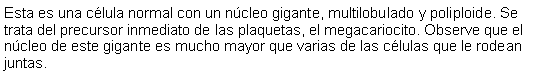 Cuadro de texto: Esta es una clula normal con un ncleo gigante, multilobulado y poliploide. Se trata del precursor inmediato de las plaquetas, el megacariocito. Observe que el ncleo de este gigante es mucho mayor que varias de las clulas que le rodean juntas. 