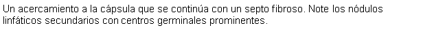 Cuadro de texto: Un acercamiento a la cpsula que se contina con un septo fibroso. Note los ndulos linfticos secundarios con centros germinales prominentes.