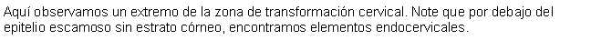 Cuadro de texto: Aqu observamos un extremo de la zona de transformacin cervical. Note que por debajo del epitelio escamoso sin estrato crneo, encontramos elementos endocervicales.