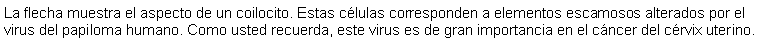 Cuadro de texto: La flecha muestra el aspecto de un coilocito. Estas clulas corresponden a elementos escamosos alterados por el virus del papiloma humano. Como usted recuerda, este virus es de gran importancia en el cncer del crvix uterino.