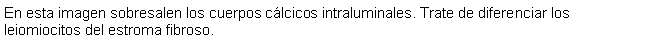 Cuadro de texto: En esta imagen sobresalen los cuerpos clcicos intraluminales. Trate de diferenciar los leiomiocitos del estroma fibroso.
