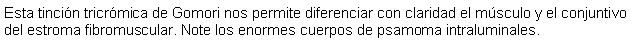 Cuadro de texto: Esta tincin tricrmica de Gomori nos permite diferenciar con claridad el msculo y el conjuntivo del estroma fibromuscular. Note los enormes cuerpos de psamoma intraluminales.